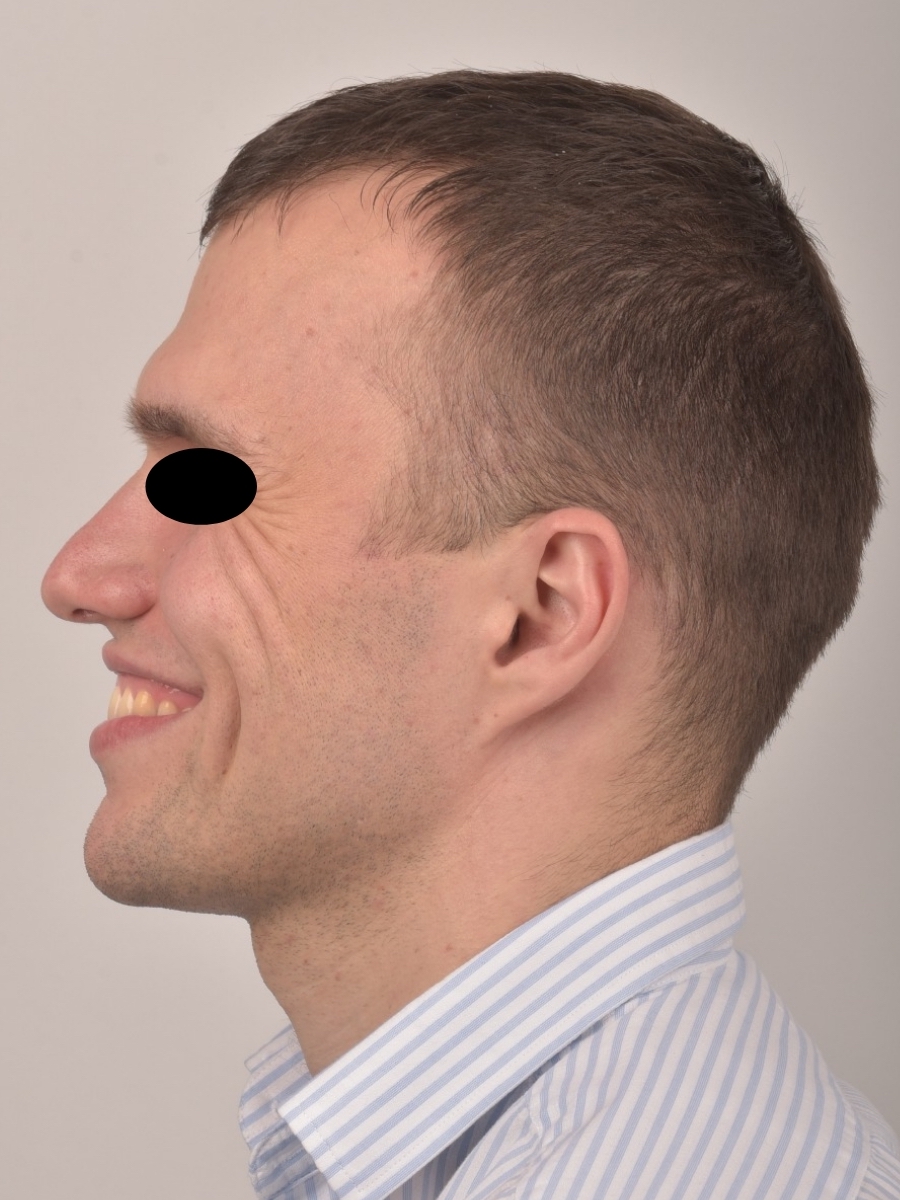 Muscatura corecta după aparat dentar